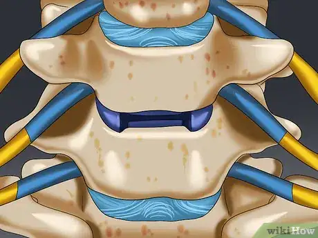 Image titled Deal With Scoliosis Surgery Step 5