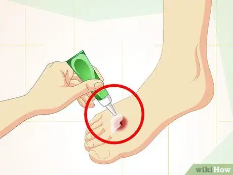 Image titled Care for Superficial Wounds Step 15