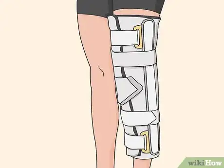 Image titled Diagnose and Treat a Tibial Plateau Fracture Step 07