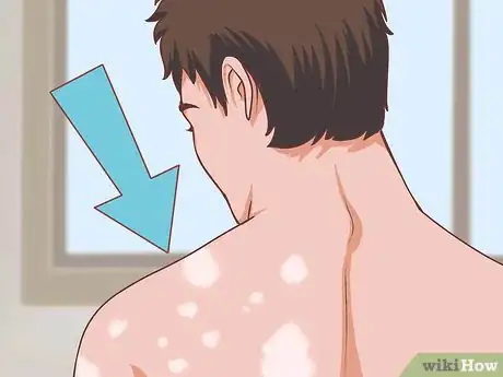 Image titled Diagnose Fanconi Anemia Step 5