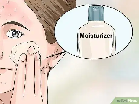 Image titled Hide Pimples Step 4