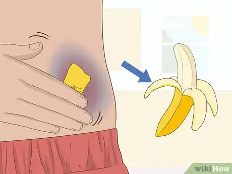 Image titled Make a Bruise Go Away Faster Step 17