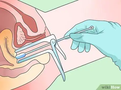 Image titled Recognize Chlamydia Symptoms (for Women) Step 10