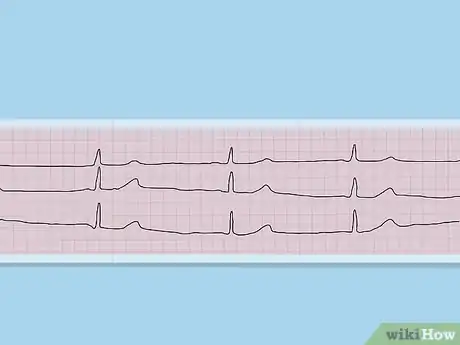 Image titled Diagnose a Heart Murmur Step 9