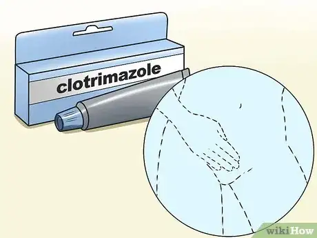 Image titled Stop Vaginal Itching Step 6