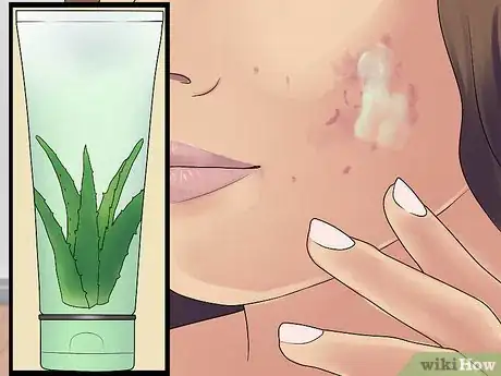 Image titled Get Rid of Cystic Acne Scars Step 3