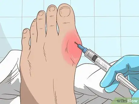 Image titled Identify Hyperuricemia Step 9