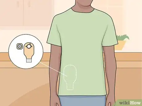 Image titled Get Used to an Ostomy Step 18