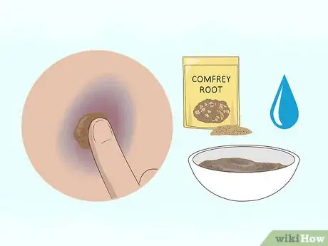 Image titled Make a Bruise Go Away Faster Step 14