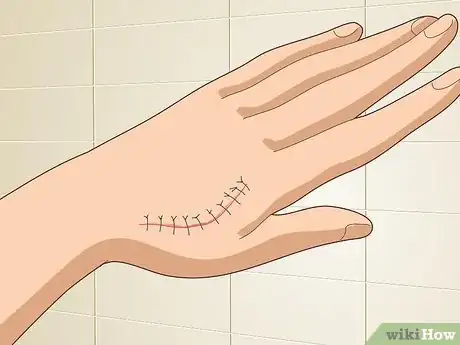 Image titled Reduce Scars Naturally Step 11