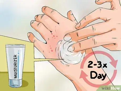 Image titled Reduce Eczema Itching Step 7
