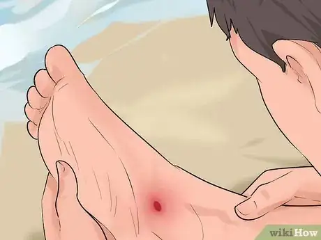 Image titled Identify and Treat Injuries From Stingrays and Sea Urchins Step 1
