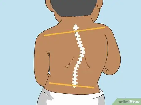 Image titled Diagnose Spinal Muscular Atrophy Step 7