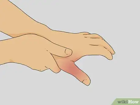 Image titled Diagnose a Broken Thumb Step 1