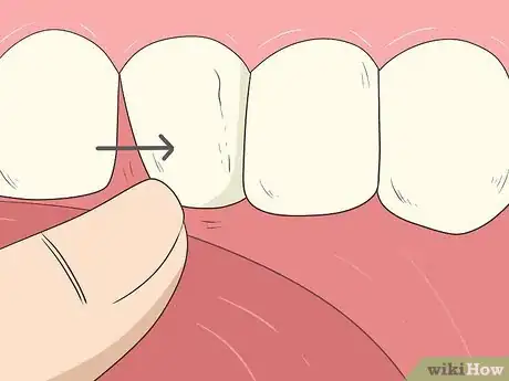Image titled Pull a Loose Tooth at Home Step 1