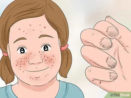 Image titled Diagnose Tuberous Sclerosis Step 5