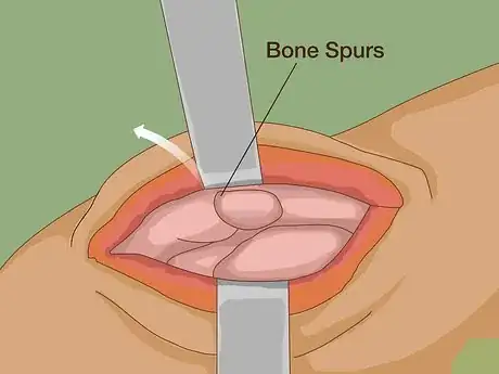 Image titled Get Muscle Tears Surgically Removed Step 7