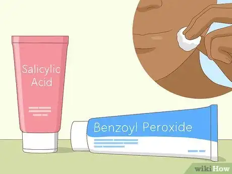 Image titled Avoid Blind Pimples Step 2