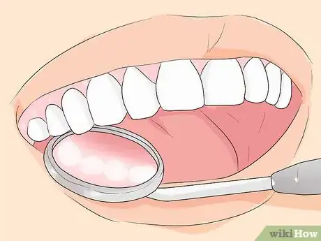 Image titled Prevent Tartar Step 11