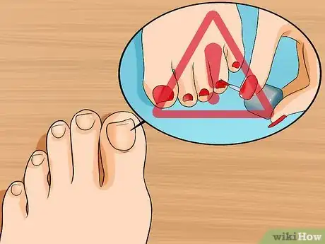 Image titled Get Rid of Yellow Toenails Step 1