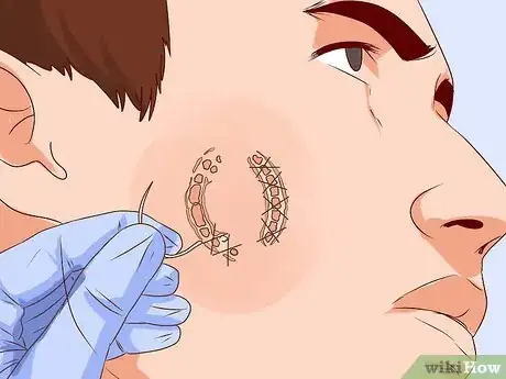 Image titled Treat a Human Bite Step 10