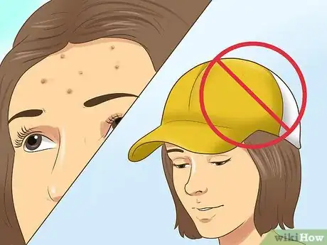 Image titled Stop Getting Acne in the Same Spot Step 1