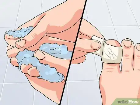 Image titled Remove a Dead Toenail Step 13