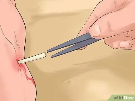 Image titled Identify and Treat Injuries From Stingrays and Sea Urchins Step 5