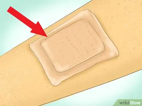 Image titled Care for Minor Abrasions and Scratches Step 5