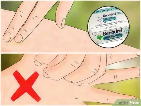 Image titled Identify Insect Bites Step 10