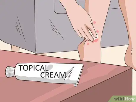 Image titled Achieve Psoriasis Remission Step 2