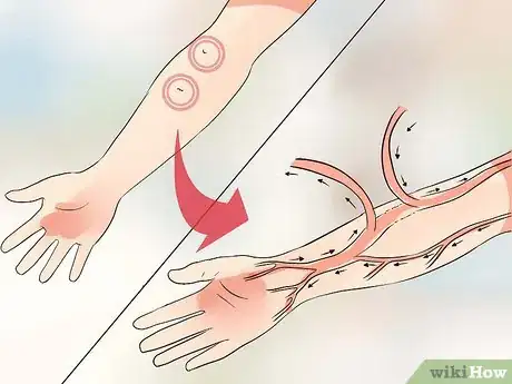 Image titled Prepare for Kidney Dialysis Step 8