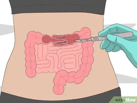 Image titled Treat Cystic Fibrosis Step 12