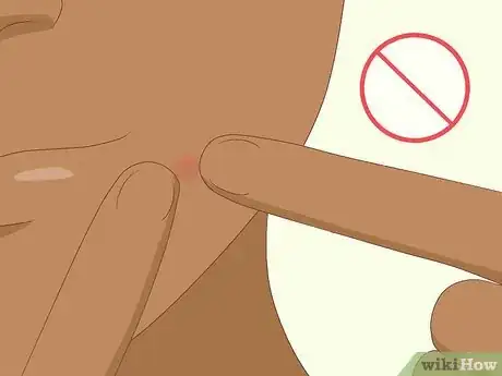 Image titled Avoid Blind Pimples Step 5