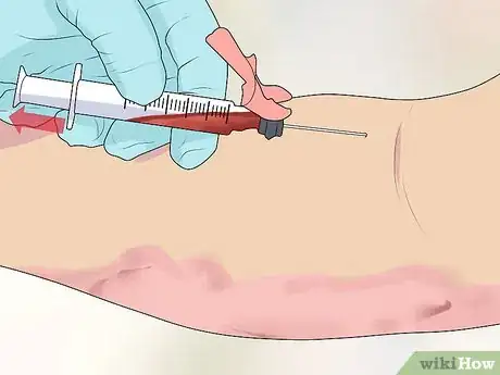 Image titled Treat Psoriasis with Biologics Step 2