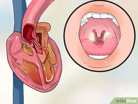 Image titled Find the Cause of Aortic Regurgitation Step 3