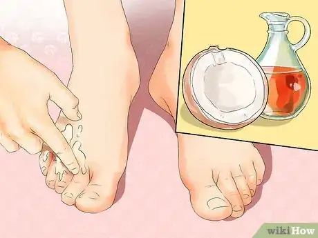 Image titled Heal Dry Skin on Your Feet Step 4