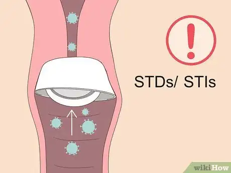 Image titled Use a Cervical Cap Step 10