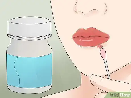 Image titled Get Rid of a Cold Sore Step 19