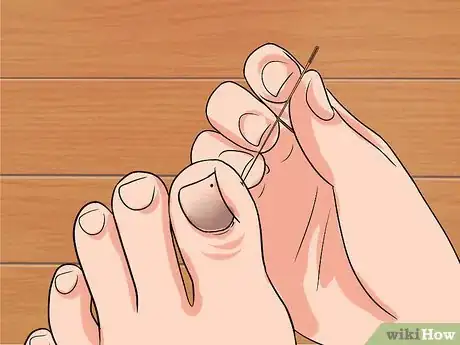 Image titled Remove a Dead Toenail Step 5