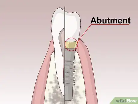 Image titled Know What to Expect when Getting a Tooth Implant Step 13