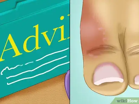 Image titled Relieve a Sore Damaged Toe Step 8