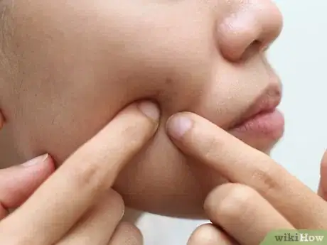 Image titled Care for Teenage Skin Step 4