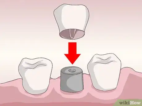 Image titled Know What to Expect when Getting a Tooth Implant Step 17