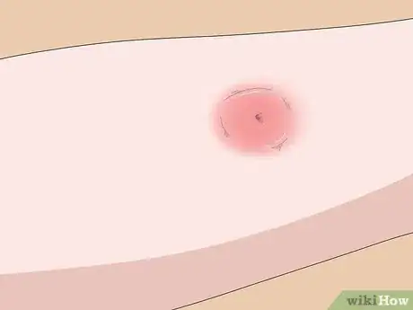 Image titled Treat Spider Bites on Kids Step 1