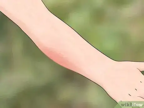 Image titled Identify Insect Bites Step 3