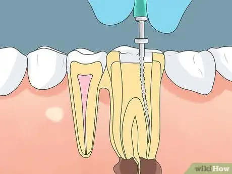Image titled Get Rid of a Tooth Infection Step 4