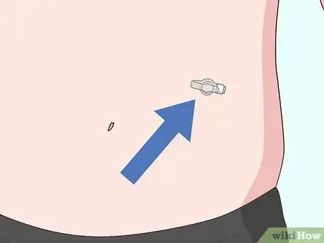 Image titled Treat Cystic Fibrosis Step 13