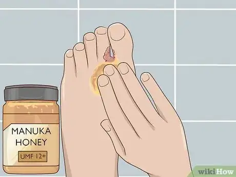 Image titled Use Honey as a Topical Antibiotic Step 9