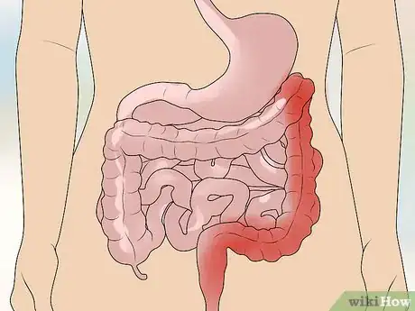 Image titled Stop Stomach Problems Step 12